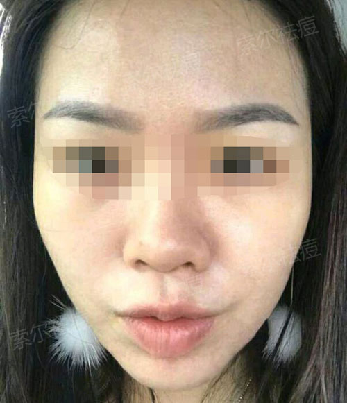 脸颊痘痘总是反复 难道只有口罩可以拯救我吗