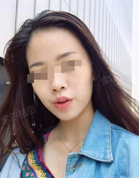 脸颊痘痘总是反复 难道只有口罩可以拯救我吗