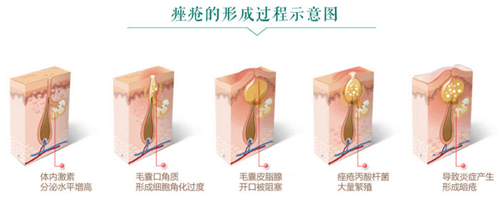 为何你总是反复长痘去不掉