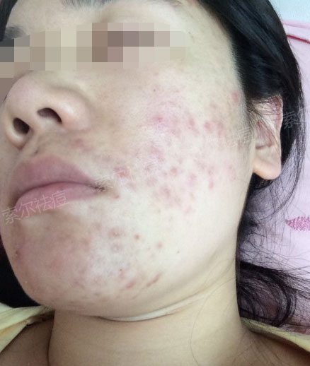 脸颊总是长痘还不是因为没用对方法