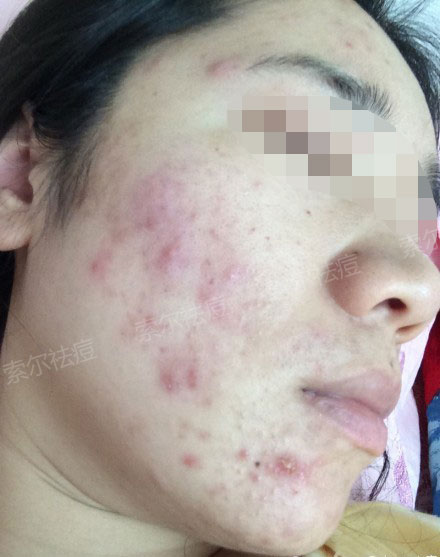 脸颊总是长痘还不是因为没用对方法