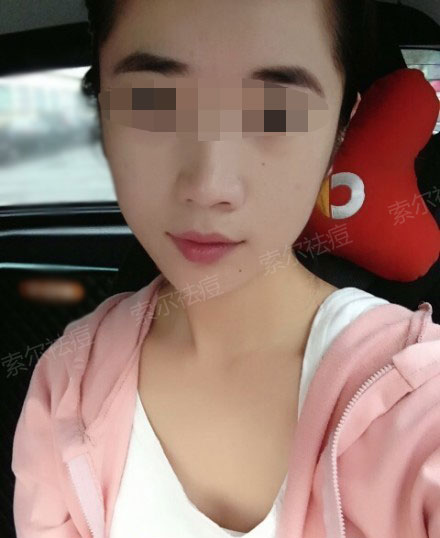 脸颊总是长痘还不是因为没用对方法