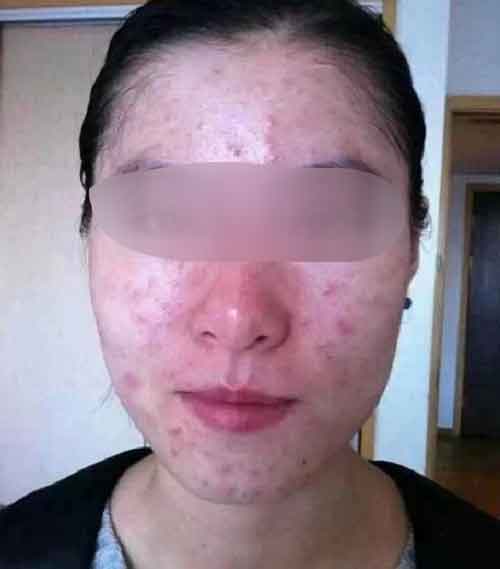 职场女性如何战胜顽固痘痘