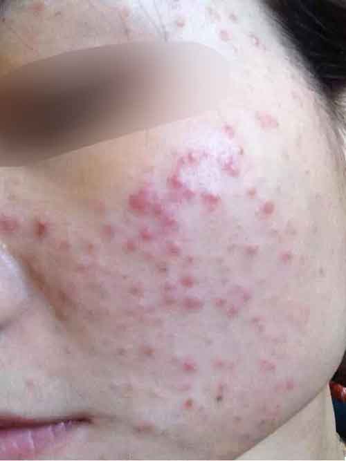 长痘六年 她用这个方法重新拥有白嫩肌肤