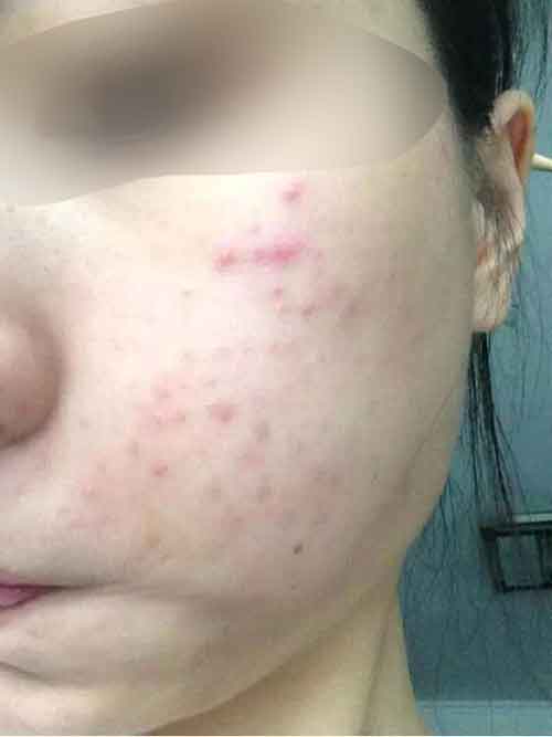 长痘六年 她用这个方法重新拥有白嫩肌肤