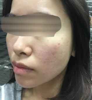 熬夜打游戏作出一脸痘如何治疗有效果