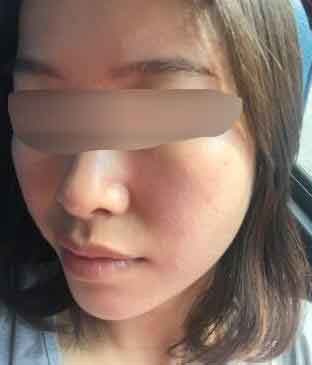 熬夜打游戏作出一脸痘如何治疗有效果