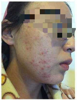 我亲身经历祛痘印的过程