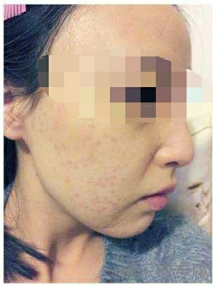 我亲身经历祛痘印的过程