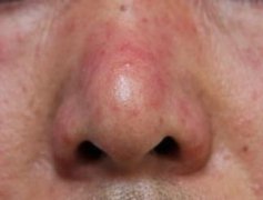 青少年去痘用什么药膏