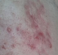 香蕉皮怎么祛痘