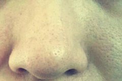 酸奶祛痘面膜怎么做