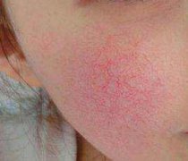 果酸祛痘的危害