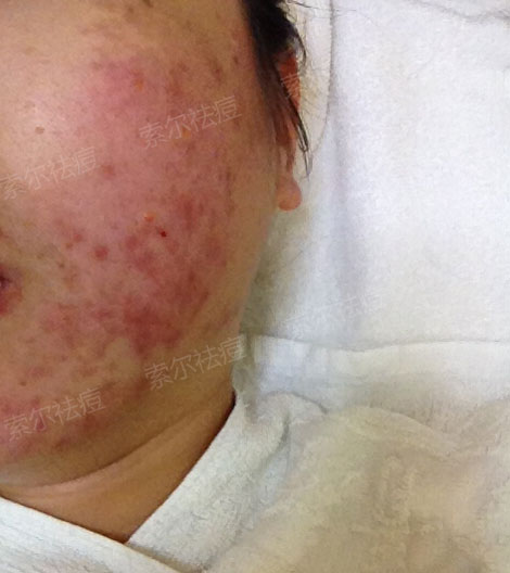 绿豆祛痘面膜怎么做