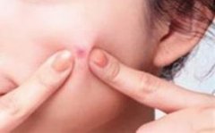 一般刮痧可以祛痘吗