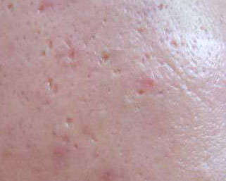 芦荟能直接涂脸上吗