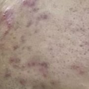 男生祛痘喝什么好