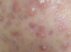 老中医祛痘产品咋样