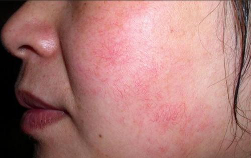 祛痘膏哪个牌子好