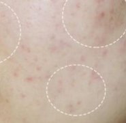 绿茶水洗脸可以祛痘吗