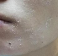 嫩肤祛痘副作用