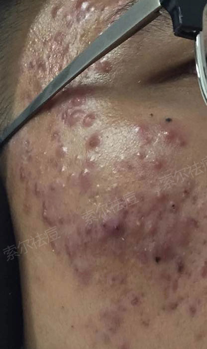 土豆可不可以祛痘