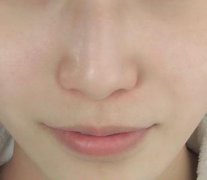 男生油性皮肤祛痘方法