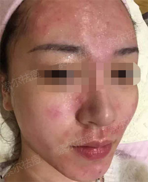 老中医祛痘产品好用吗