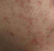 喝柠檬水能祛痘吗