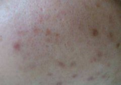 油性皮肤祛痘护肤品推荐