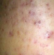 斜颈导致的脸歪怎么办